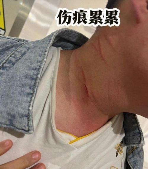 2025全年免费资料大全和脖子被扎多根烧烤签与被烧烤签子扎出血了